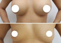 Augmentarea mamară, o operaţie vedetă
