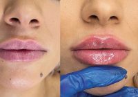 Totul despre tehnicile exclusive de injectare a buzelor:  Russian Lips, Kendall Lips sau Kylie Lips